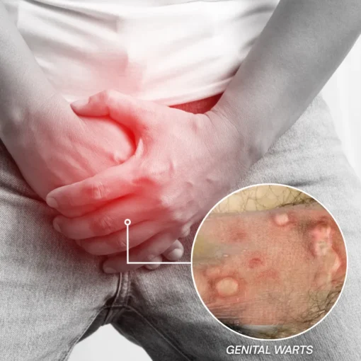 UFCOU® HPV Genital Warts Relief Cream - Image 2