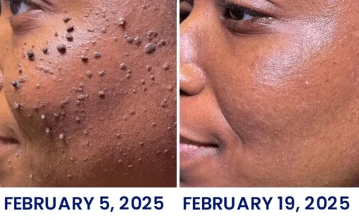 AnnieCare® Skin Tag Cryo Treatment Spray - Image 4