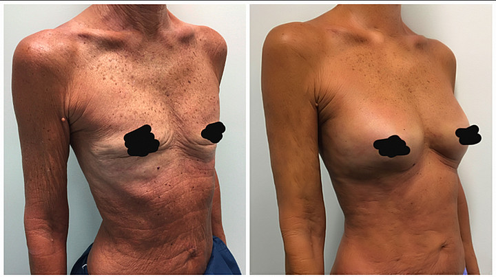 AnnieCare® Natural Detox Slimming & Breast Enhancement Capsules - Image 3