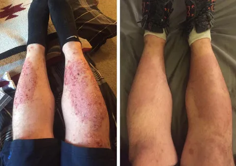 AnnieCare® Psoriasis Treatment Spray - Image 3